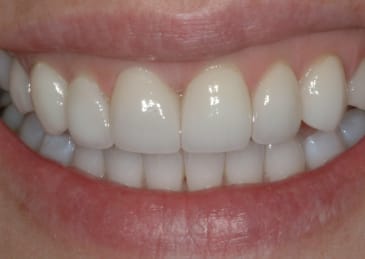 teeth after a cosmetic procedure