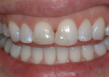 teeth before cosmetic procedure