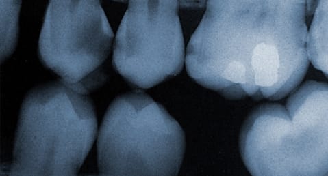a few teeth showing in a dental x-ray