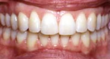 teeth after a invisalign procedure