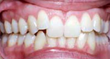 teeth before invisalign procedure