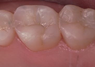 teeth after a restorative procedure