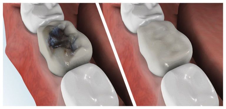 Replacing Old Silver or Gold Amalgam Fillings